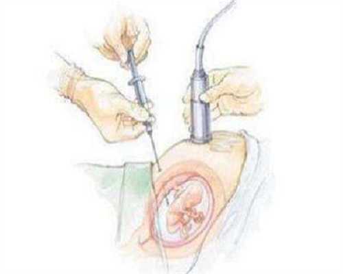 试管2胎成功率-试管2胎多少钱一次啊