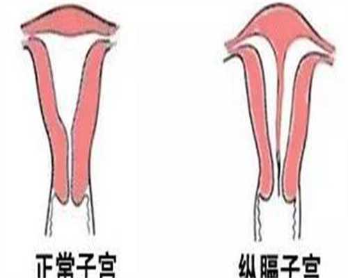 最靠谱代孕中心,腺肌症和子宫内膜异位症的区别是什么？腺肌症和子宫内膜异